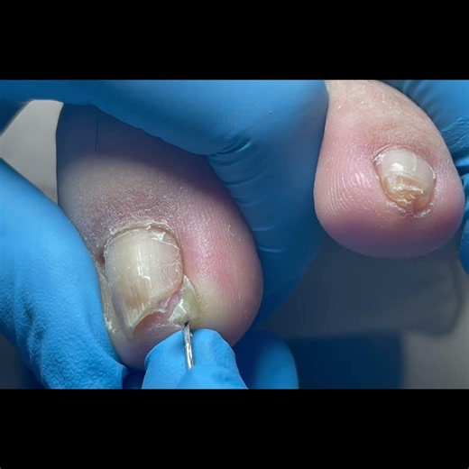 Quickly trim away the ingrown nail! #nails #pedicure