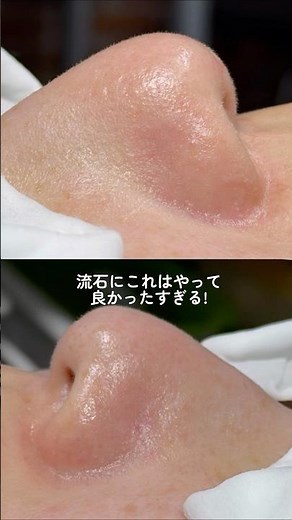 いちご鼻を治せる方法って知ってる?🍓🫧実は、痛みもダウンタイムもなく毛穴汚れを根こそぎ吸引！直後にはちゅるん肌を手に入れられるの✨#毛穴洗浄 #エクソソーム毛穴洗浄 #毛穴 #毛穴ケア #肌管理