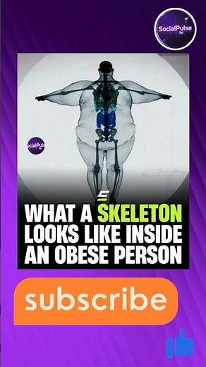 What a Skeleton Looks Like Inside an Obese Person 😮 | Medical Reality Explained