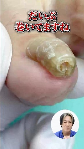 【BeforeAfter】爪切りが絶対にできない筒状の巻き爪をご紹介！当店の施術で正常化！