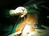 Single Incision Laparoscopic TEP / SILS TEP • Video • MEDtube.net