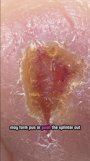 “Tiny Splinter, Big Pain: What Happens When Something Gets Stuck Under Your Skin!” 😱