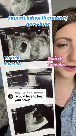 Superfetation Pregnancy: My Double Pregnancy Journey