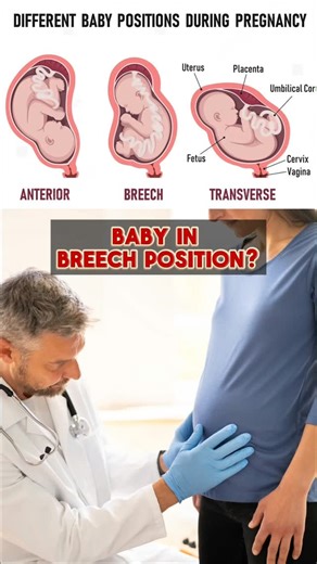 Divine Baby on Instagram: "Baby in breech position? 🤰 Don’t panic — some gentle movements may help 🌸 (Always practice with your doctor’s approval.) ✨ Try these gentle prenatal movements: 1️⃣ Cat–Cow posture – twice a day 2️⃣ Ustrasana (modified & supported) 3️⃣ Breech-encouraging pose (under guidance) 4️⃣ Lean forward while sitting to give baby space These movements help with: ✔️ Pelvic openness ✔️ Better gravity support ✔️ Baby’s natural movement 💡 Remember: Gentle, consistent practice > for