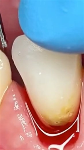 Satisfying Tooth Extraction 🦷 #shorts #extraction #satisfying #simulation #asmr