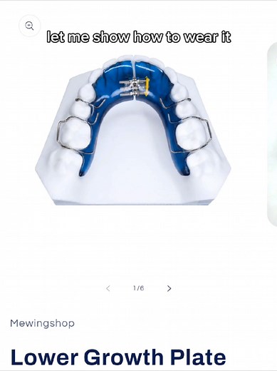 Palate Expander: Transforming Crowded Teeth Effectively