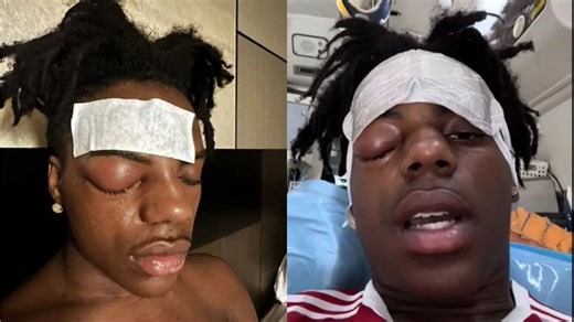 IShowSpeed is reportedly undergoing eye surgery related to cluster headaches