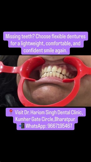 Restore your smile with removable flexible dentures—natural look, perfect fit.#removable denture