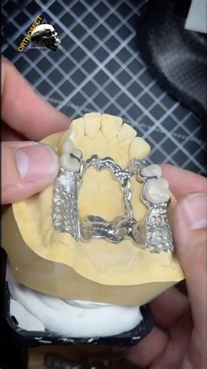 metal partial dentures with clasps. #dentures #rehab #smile