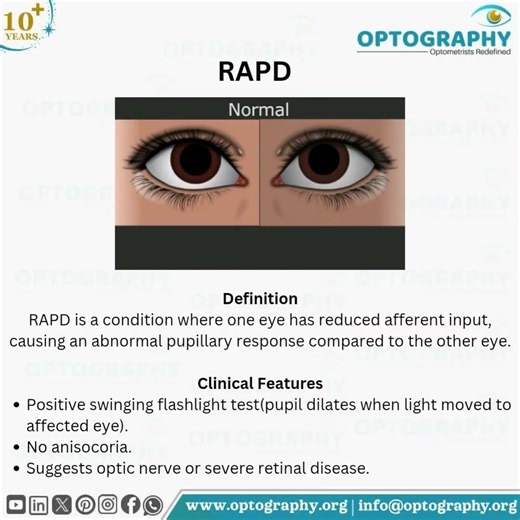 RAPD: A small pupillary sign revealing major optic nerve issues. #Optometry #RAPD #ClinicalSkills #EyeExamination #Optometrist #Optography #Thatoptometrist | Optography