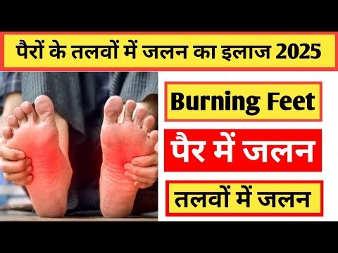 Burning Feet Problem? Simple homeopathic treatment for burning feet