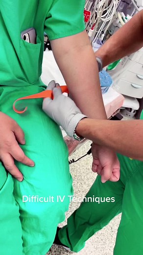 Anesthesia techniques for difficult IVs 1. Flick the vein several times and rub area with heat (Christina Vanliere, CRNA) 2. Use a double tourniquet to improve venous dilation (either double distal or one proximal and one distal) 3. Good location - vein first metacarpal 2nd finger #Anesthesiahacks