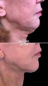 Before & After Face/Neck Lift