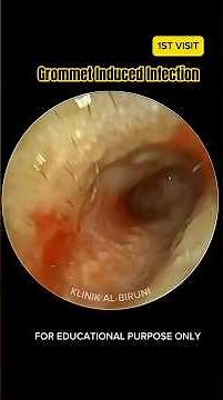Grommet Induced Infection #earwaxremoval #ear #satisfying