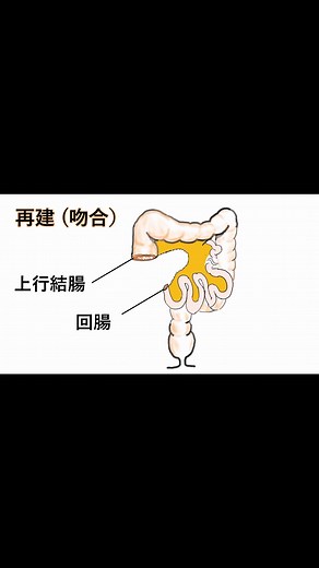 #盲腸癌 #手術方法 #解説動画 #回盲部切除 #スマップ #中居 #入院後の流れ