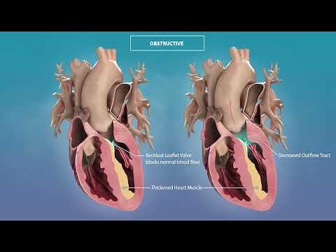 Tell Me More: Hypertrophic Cardiomyopathy