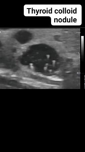 Thyroid colloid nodule #viralreelsシ #viralvideoシ #educationalreels #radiology #education #medical #ultrasound #thyroid | Radiology Interesting