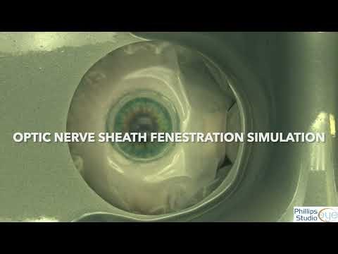 Optic Nerve Sheath Fenestration Simulation (ONSF)