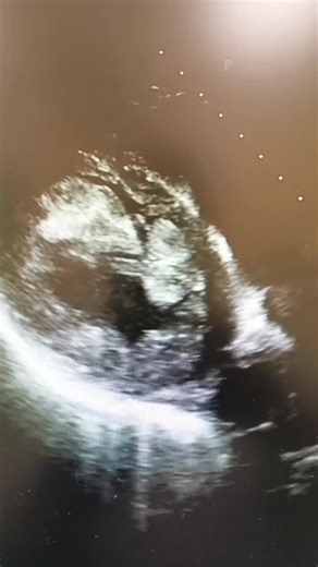 Heart Failure and Apical Thrombus Overview