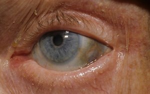 Alkaptonuria causes, genetics, symptoms, diagnosis & alkaptonuria treatment