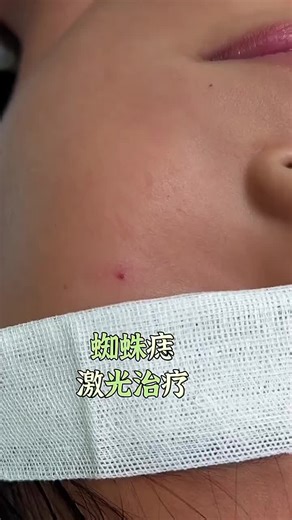 Laser Mole Removal on TikTok