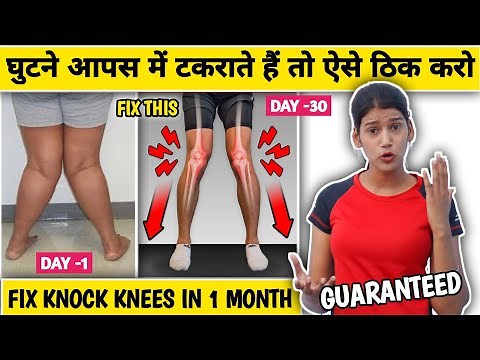 Correct Knock Knees In 1 Month |EFFECTIVE Exercises To Fix Knock Knees For Forever