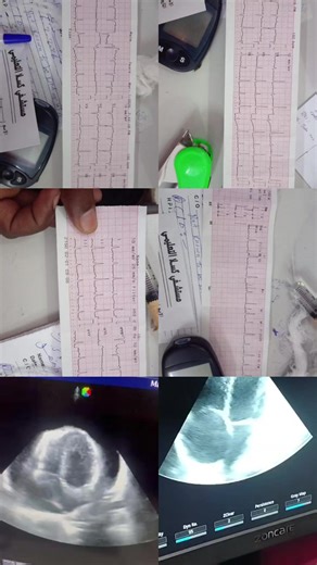 Managing Hypothyroidism Complications in a 30-Year-Old
