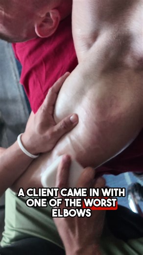 Knot infested arm finds GREATER Relief | muscle knot