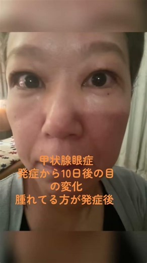 【バセドウ病】アイソトープ後甲状腺眼症になって治療開始１０日後の目の変化です #50代 #バセドウ病 #甲状腺眼症#病院