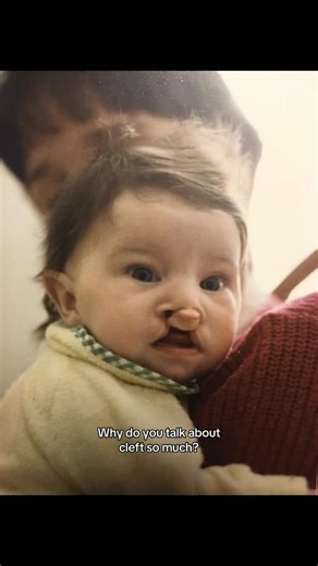 I talk about cleft so much for all the versions of me that have been and all the versions of me that will be. I talk about cleft so much because when I was growing up, there wasn’t someone talking about it, reassuring me that I’d be okay. I talk about cleft so much for me, but also for the people out there who need to see their experience reflected in the world. #cleftstrong #differentisbeautiful #cleftproud | CleftLove: Learning to Love My Smile