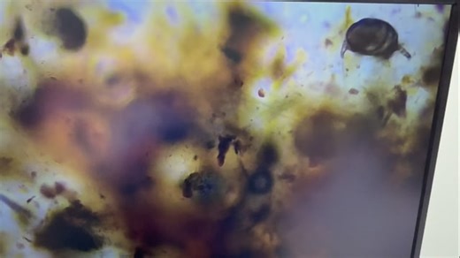 Lifeline Veterinary Urgent Care on Instagram: "🐾 Case of the Month: Ear Mites in Cats 🐾 This month at Lifeline Veterinary Urgent Care, we’re shining a spotlight on a very common—but very itchy—feline problem: ear mites. 🐱 The Case: A sweet kitty came in for nonstop ear scratching, head shaking, and crusty, dark debris in their ears (often described as looking like coffee grounds). Our exam revealed the culprit: ear mites, a highly contagious parasite that’s especially common in kittens and mu