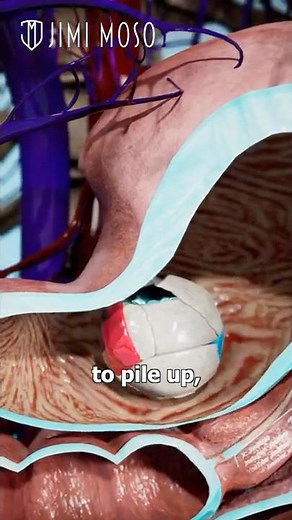 Gum Stuck in Stomach?! 😳 Bezoar Explained #shorts #science #medical #medicalstudent #gum