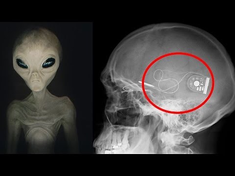 Der BEWEIS für ALIENS - Mediziner findet ALIEN Implantate bei Operationen | MythenAkte
