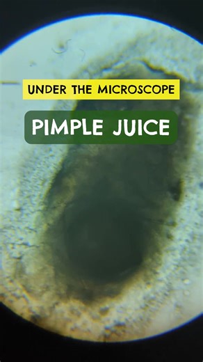 Exploring Microscopic World: Pimples, Microorganisms, and Cells