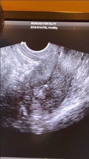 How Does an EMBRYO TRANSFER Work? Live #EmbryoTransfer Demo