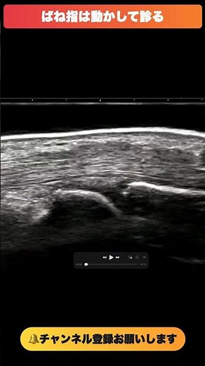 ばね指、動かすと見える引っかかり｜エコー動的評価