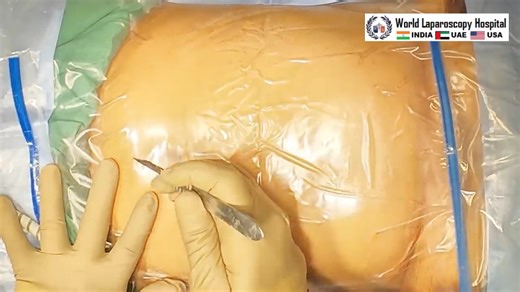 Laparoscopic Cholecystectomy — Skin to Skin Surgery | Step-by-Step Gallbladder Removal at WLH