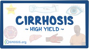 Cirrhosis: Pathology review: Video, Causes, & Meaning | Osmosis