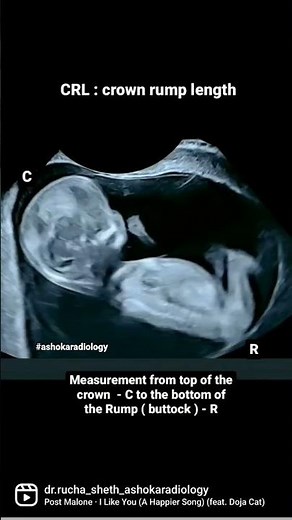 CRL : crown rump length measurements in fetal ultrasound.