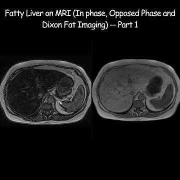 Fatty Liver on MRI (In phase, Opposed Phase and Dixon Fat Imaging) Part 1 #fattyliver #radiology