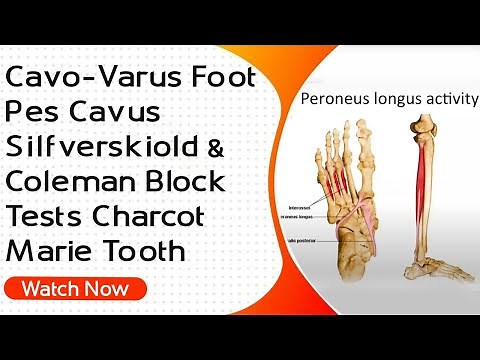 Cavo-Varus Foot | Pes Cavus | Silfverskiold & Coleman Block Tests Charcot Marie Tooth