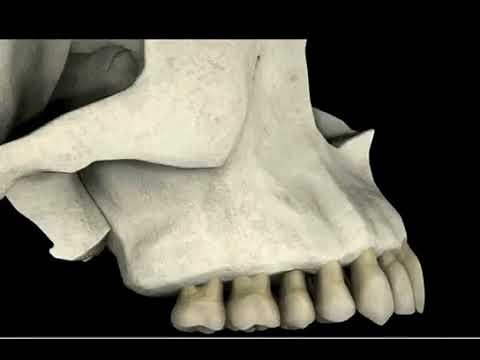 Upper Jaw bone Shrinking (Bone Atrophy) from tooth loss (Extraction, Periodontal Disease, Trauma)