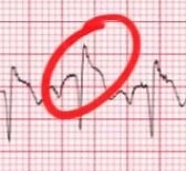 Two STEMI Mimics You've Got to Know! — Downeast Emergency Medicine