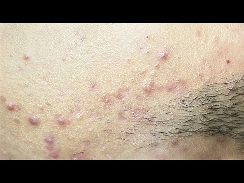 Deep Blackhead Extraction | Relaxing Facial Treatment #722 . Bao is in 12th Grade P4