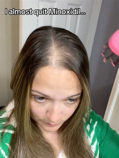 Day 12 hair check 👀 Minoxidil Shampoo routine#MinoxidilShampoo #HairGrowth #HairCarePH