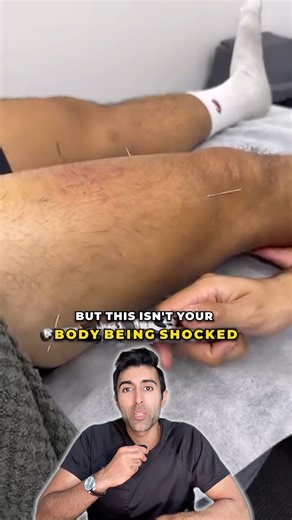 Kunal Sood, MD on Instagram: "Electroacupuncture uses a mild electrical current passed between acupuncture needles to stimulate nearby nerves and muscle fibers. The small, rhythmic twitches you see are normal and show that the current is activating the area. This stimulation helps improve blood flow, release endorphins, and modulate nerve signals to reduce pain. The twitching stops once the current is turned off. Electroacupuncture does not cure the underlying condition but can temporarily relax