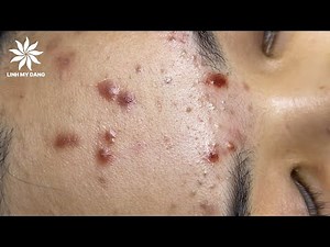 Relaxing Acne Treatment #22 | Girl Acnes