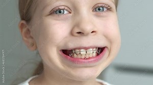 Lengthening the dentition and shifting teeth using removable orthodontic appliances. A child smiles widely with a plate in his mouth, Functional devices for aligning the bite in the mouth close-up