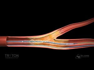 Tryton Side Branch Stent: Deployment Sequence