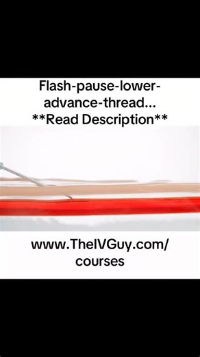 Brian “The IV Guy” on Instagram: "This clip demonstrates two techniques I talk about frequently. . Since the catheter sits behind the bevel of the needle, it’s still in the wall of the vein when you first see flash. Lowering your angle and advancing 2-6mm will ensure the catheter is all the way in the lumen of the vein, and will limit catheter contact with the vein wall while threading. . Tamponade can help stop blood from flowing out of the catheter after you remove the needle (if you aren’t us
